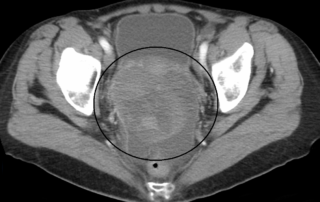 CT or large ovarian carcinoma